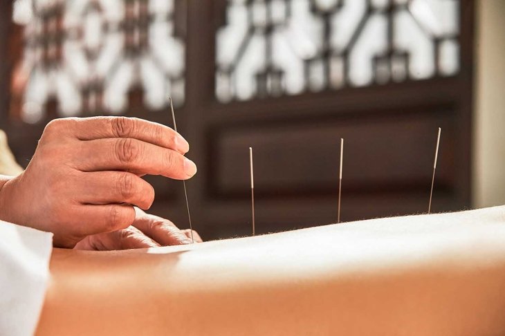The doctor of traditional Chinese medicine acupuncture
